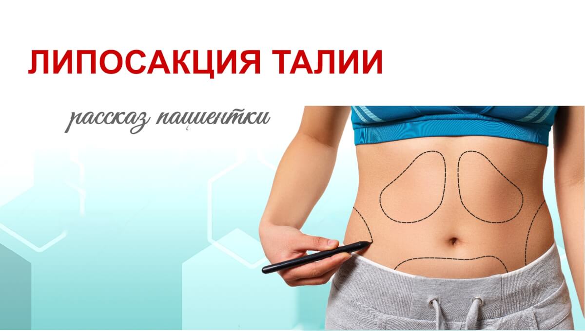 Липосакция. Рассказ пациентки