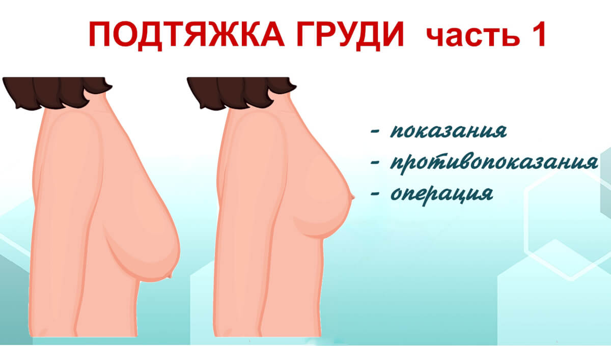 Тема месяца — Подтяжка груди. Часть 1