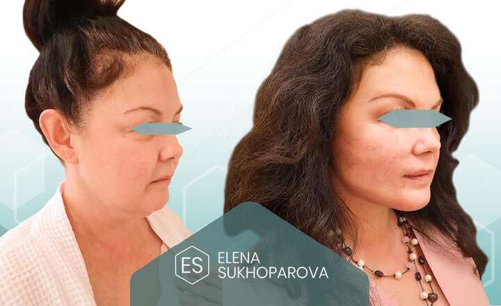 Подтяжка лица