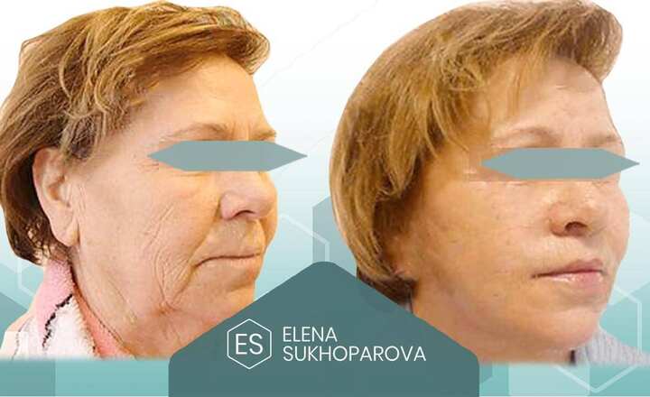 Подтяжка лица