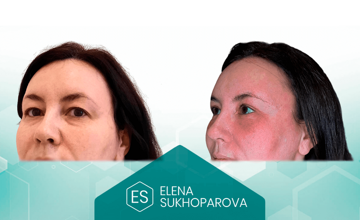 Подтяжка лица