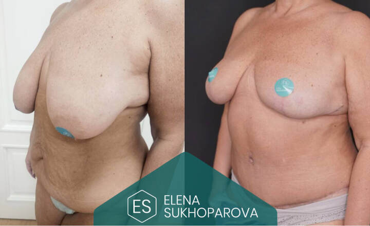 Пластика живота