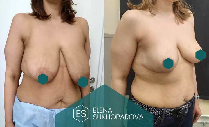 Подтяжка и уменьшение груди