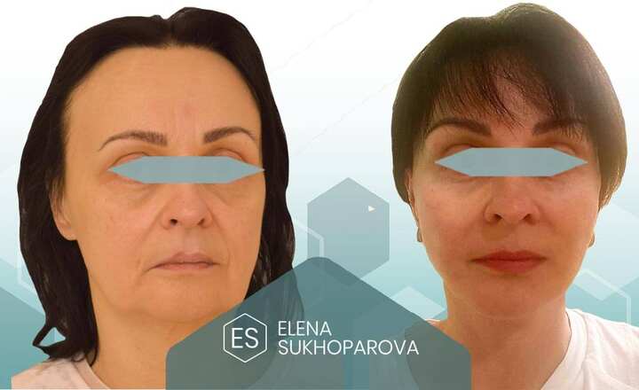 Липофилинг