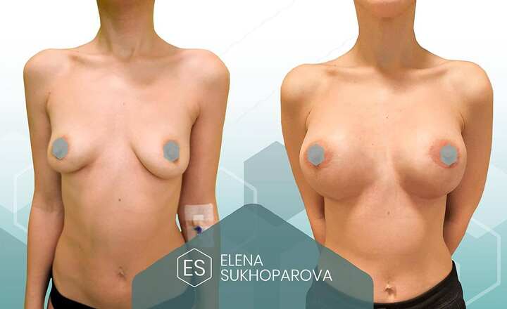 Увеличение груди