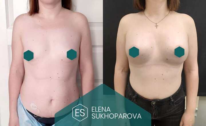 Увеличение груди
