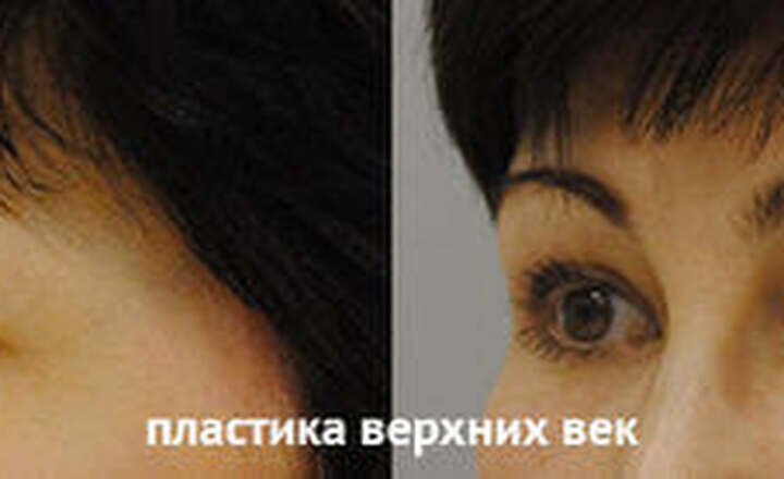 Блефаропластика и эндоскопия