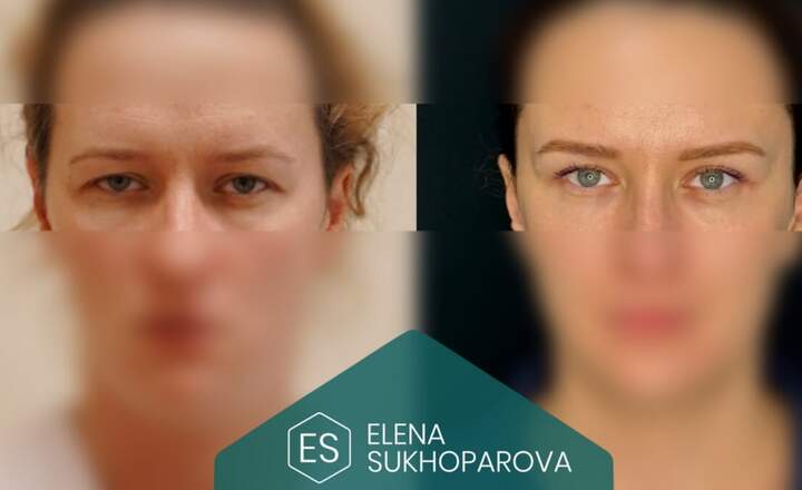 Блефаропластика и эндоскопия