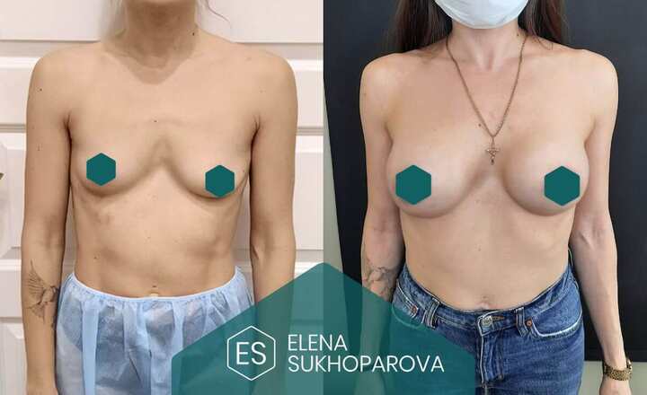 Увеличение груди