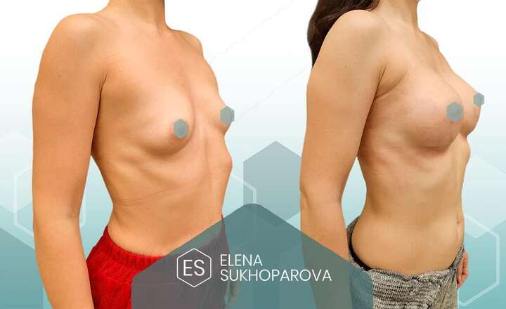 Увеличение груди