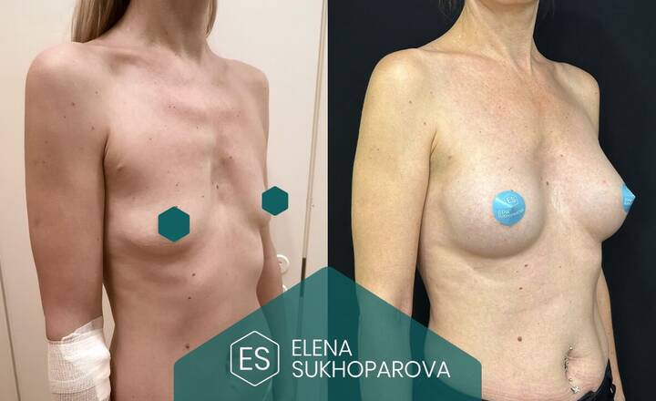 Увеличение груди