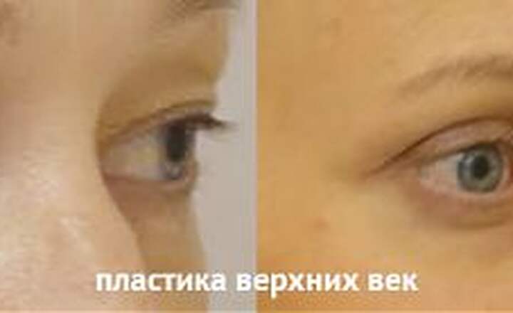 Блефаропластика и эндоскопия