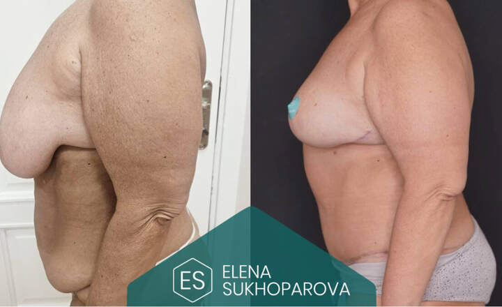 Пластика живота
