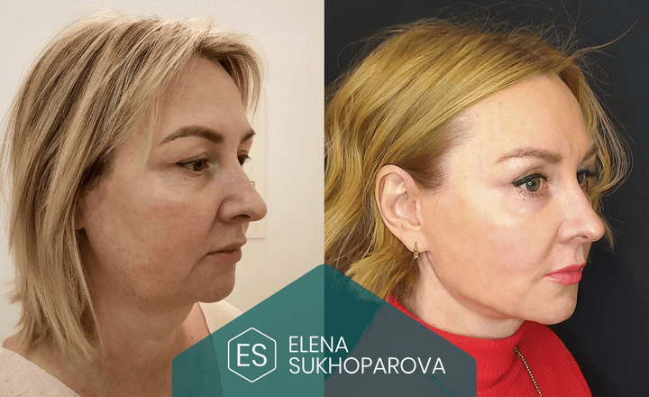 Подтяжка лица