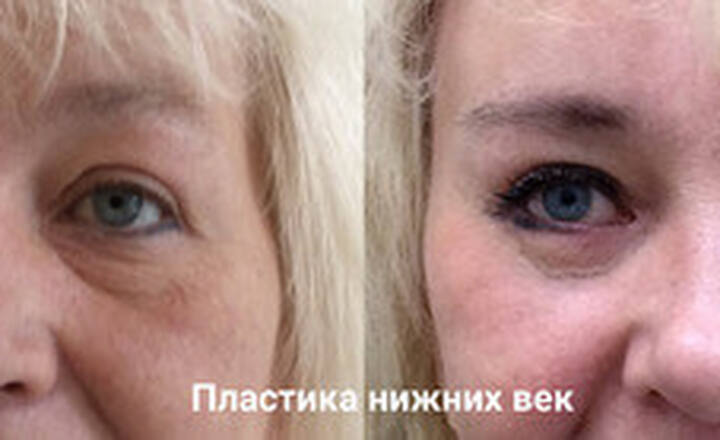 Блефаропластика и эндоскопия