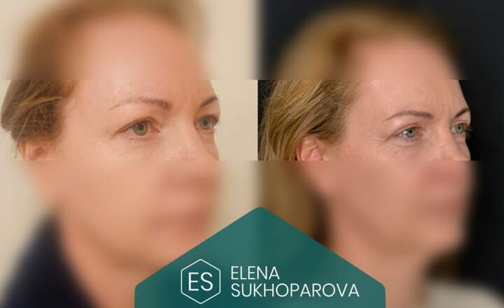 Блефаропластика и эндоскопия