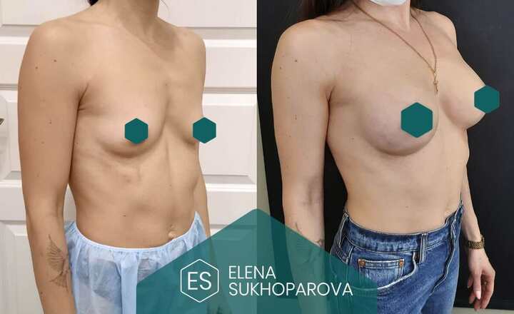 Увеличение груди