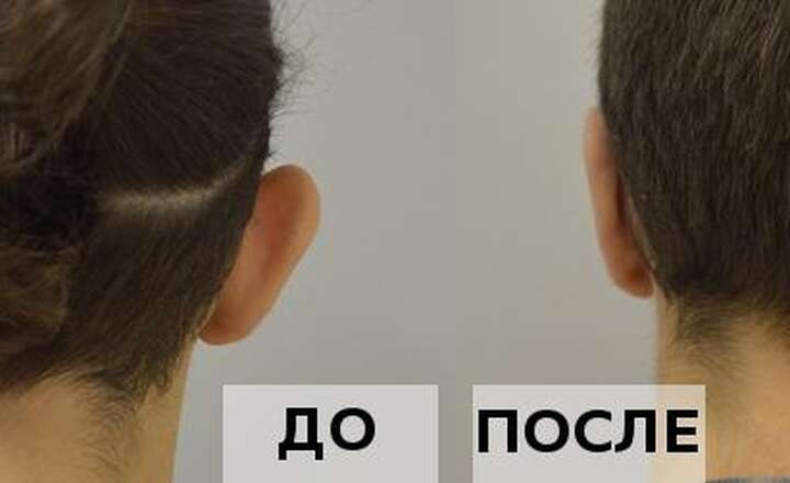 Отопластика