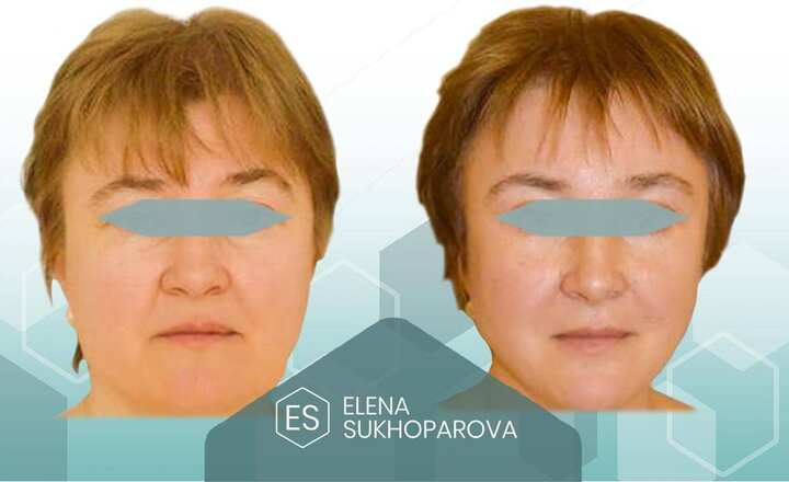 Подтяжка лица