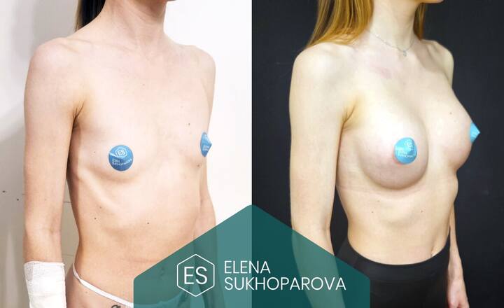Увеличение груди