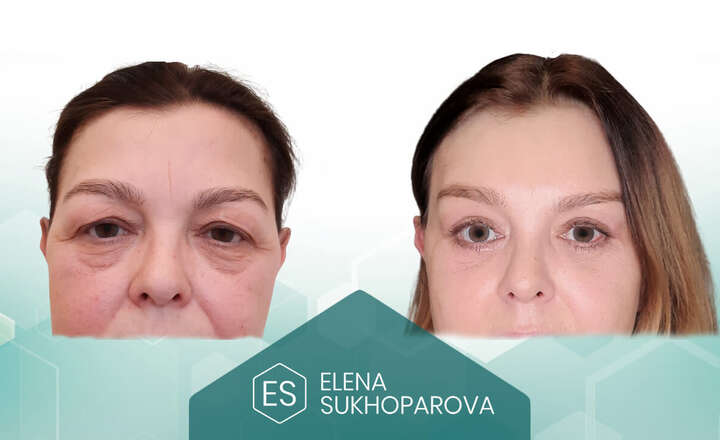 Подтяжка лица