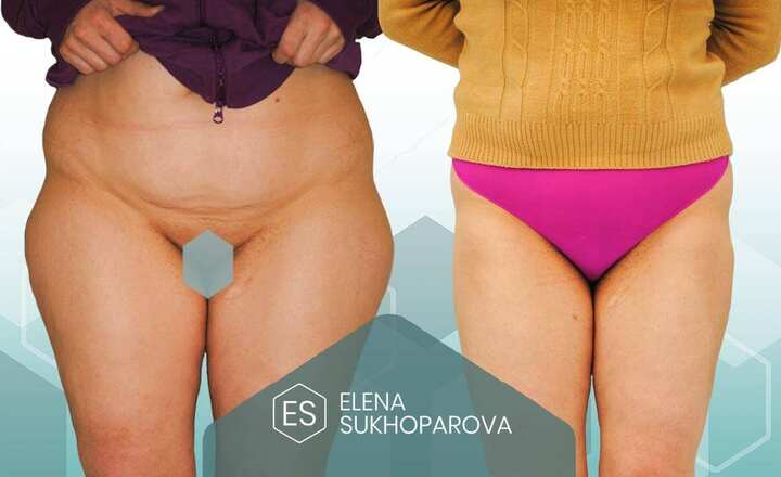 Липосакция