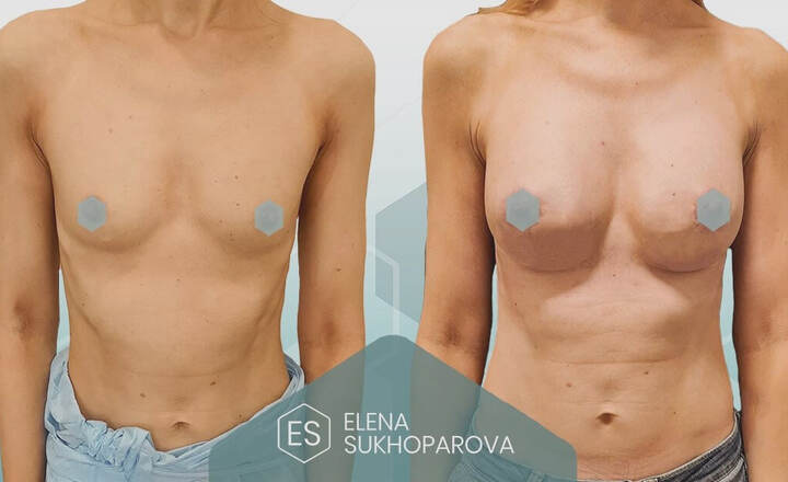 Увеличение груди