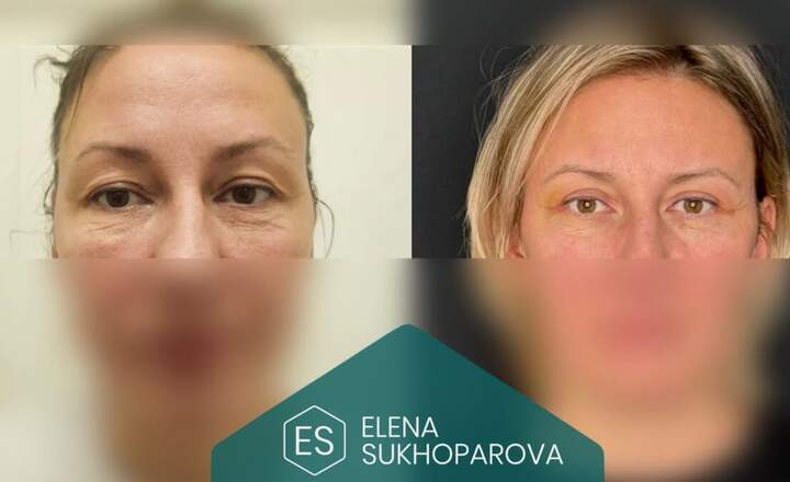 Блефаропластика и эндоскопия