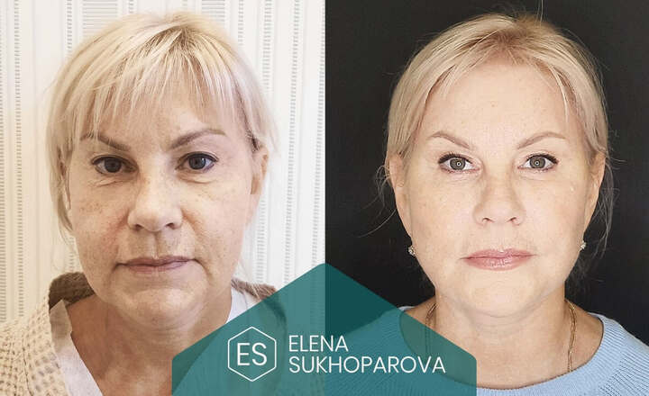 Подтяжка лица