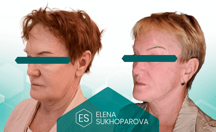 Подтяжка лица