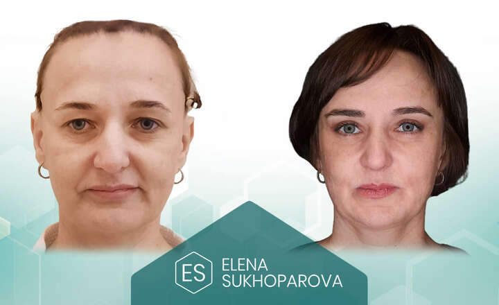 Подтяжка лица