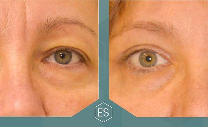 Блефаропластика и эндоскопия