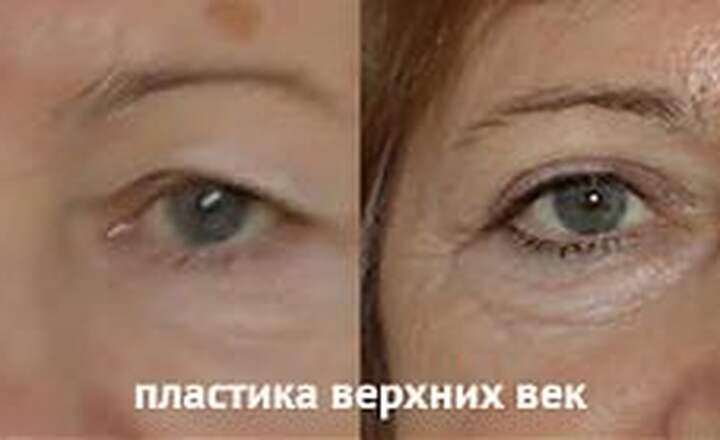 Блефаропластика и эндоскопия