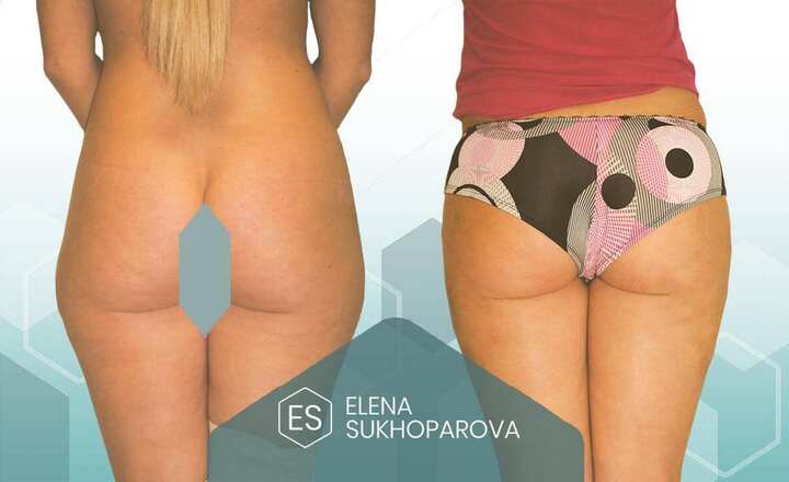 Липосакция