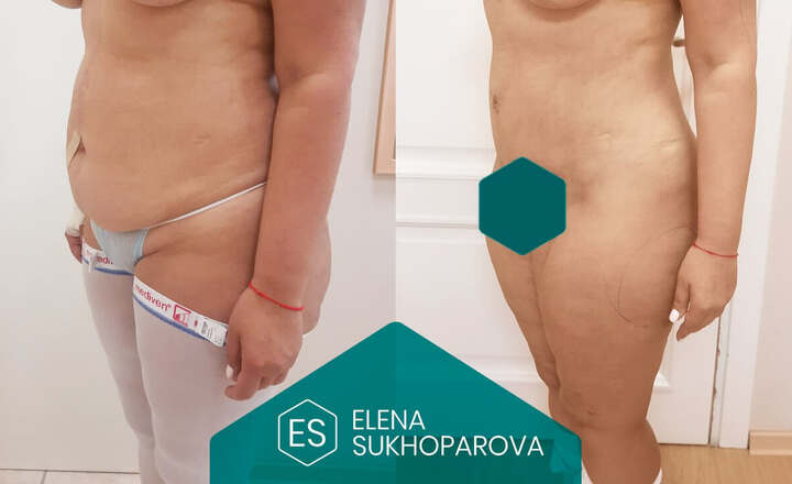 Пластика живота