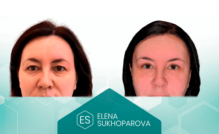 Подтяжка лица