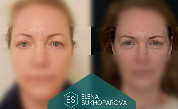 Блефаропластика и эндоскопия