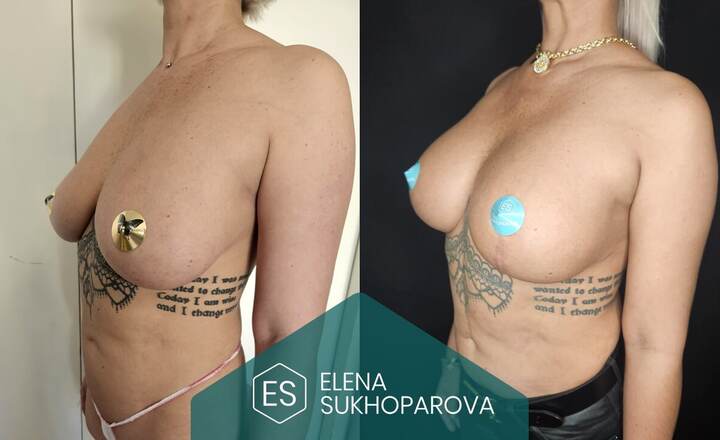 Подтяжка и уменьшение груди