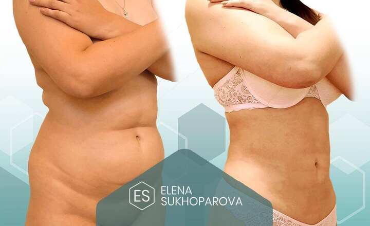 Липосакция