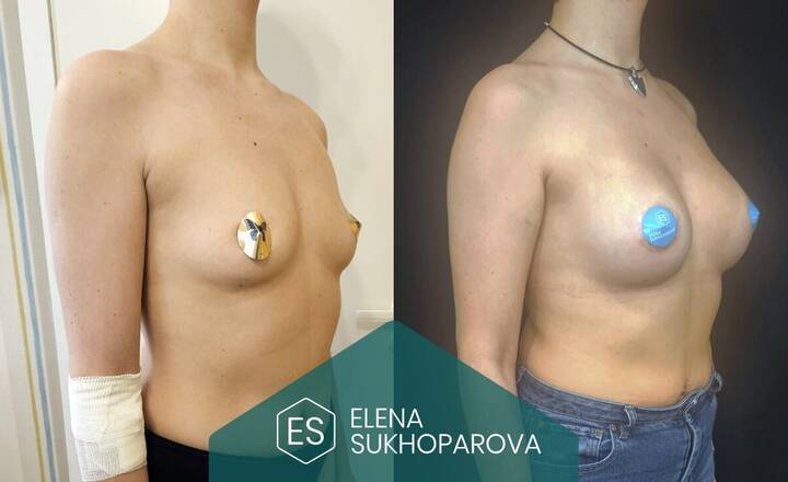 Увеличение груди