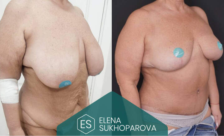 Пластика живота