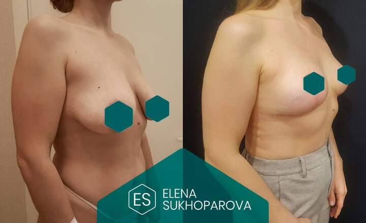 Подтяжка и уменьшение груди