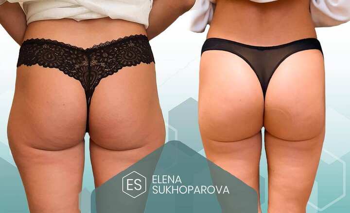 Липосакция