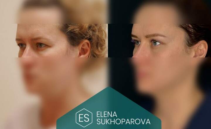 Блефаропластика и эндоскопия