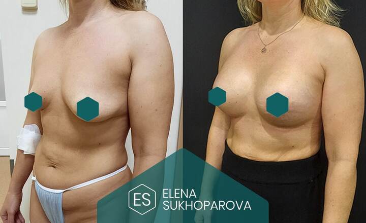 Увеличение груди
