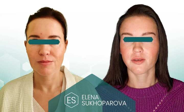 Подтяжка лица
