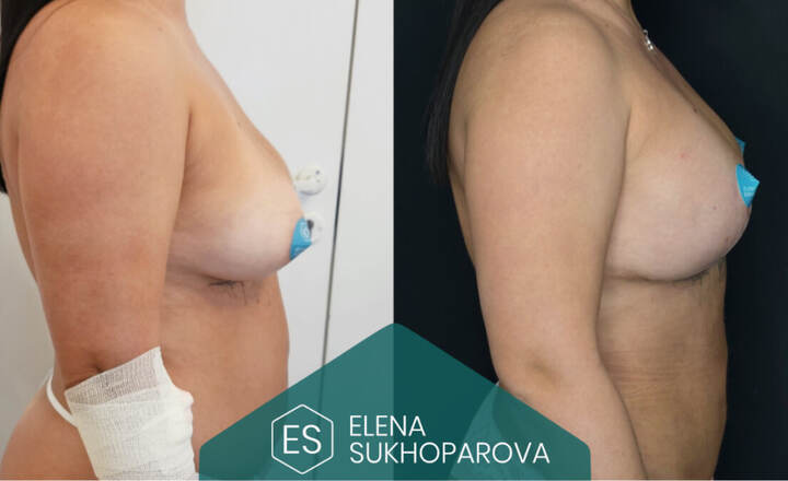Липосакция