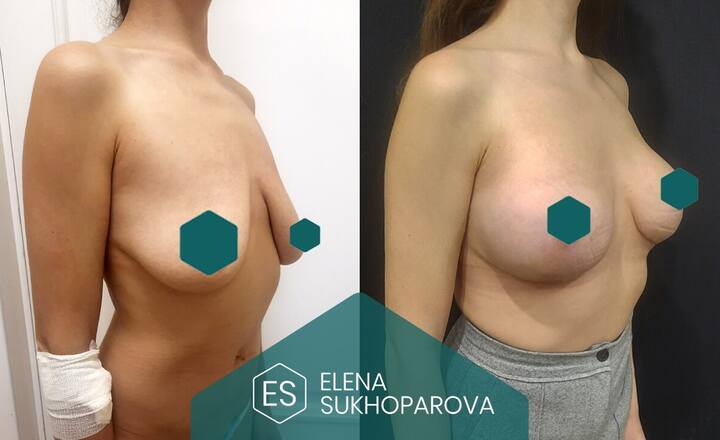 Подтяжка и уменьшение груди
