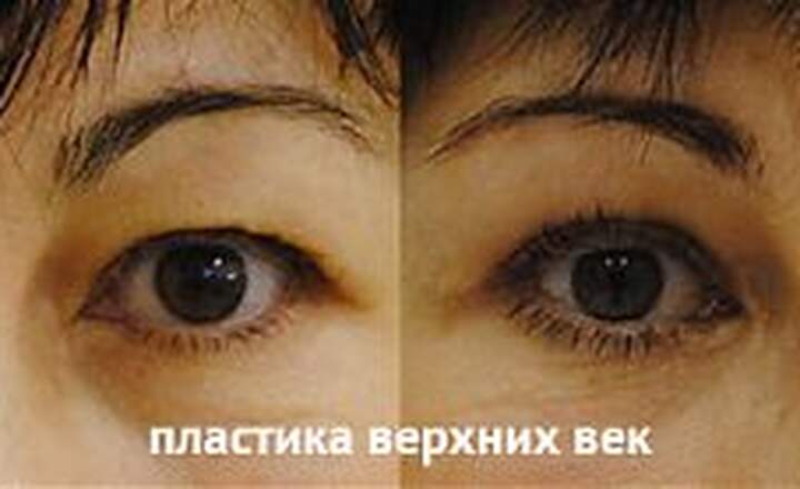 Блефаропластика и эндоскопия