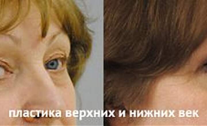 Блефаропластика и эндоскопия